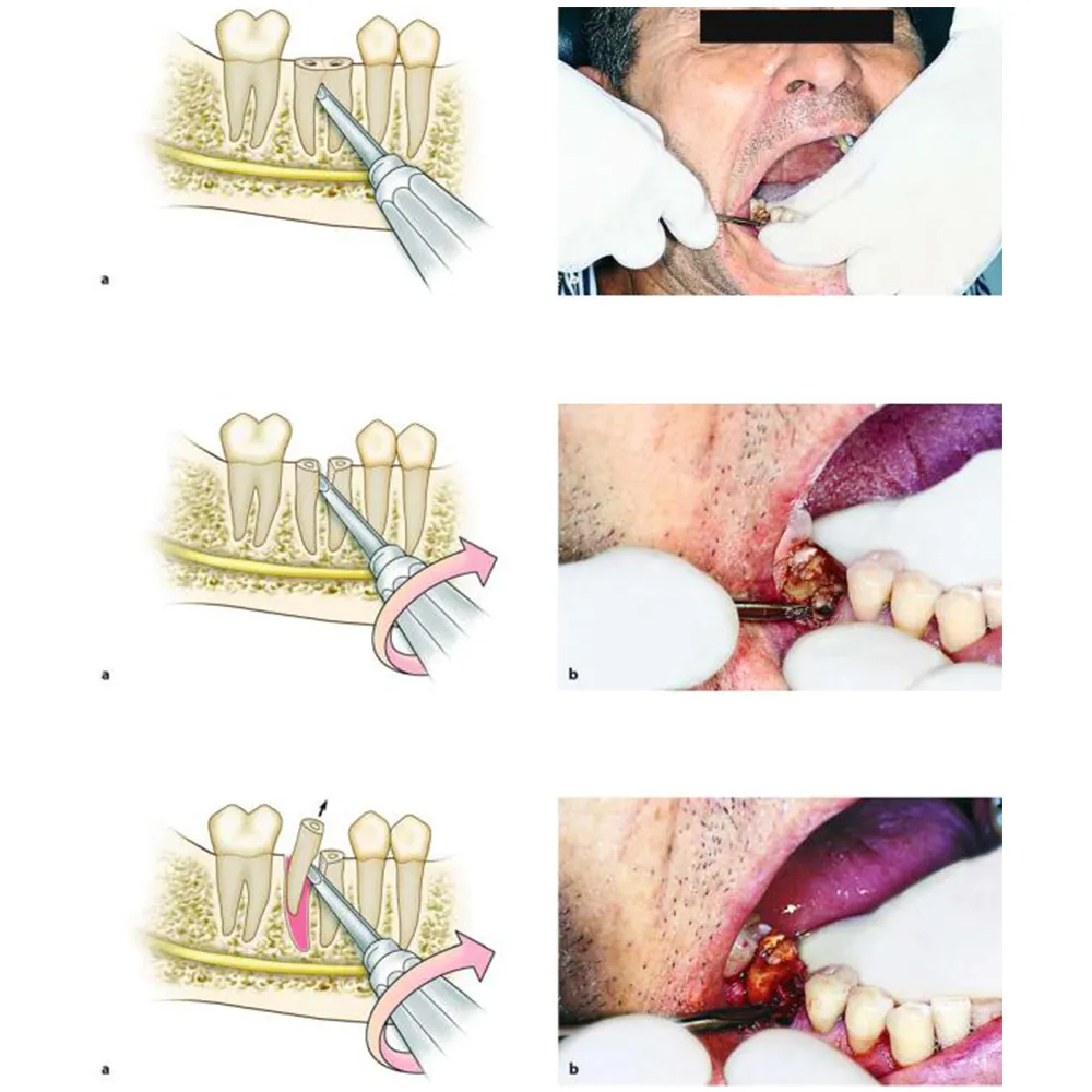 waldent-lindo-levian-root-elevator-straight-3x8mm-2122